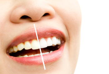 dr-essencial-clareamento-dentario-dentes-odontologia-